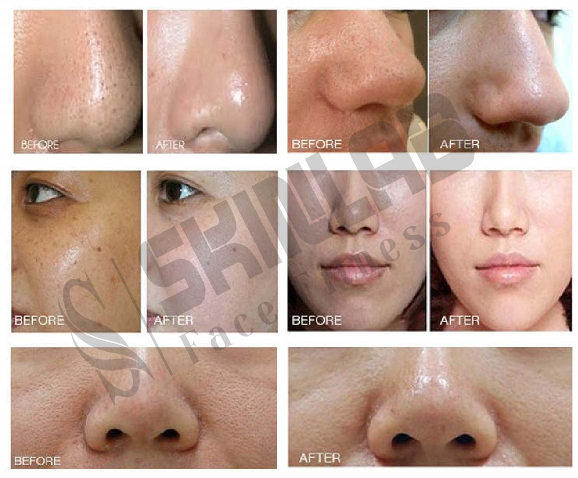 Hydra Facial + Oxygen Therapy