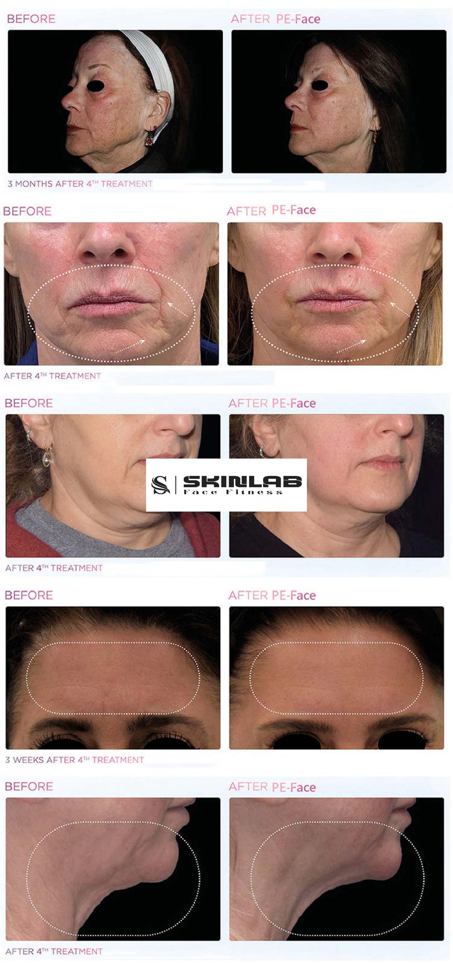 Emface Canberra. Ultraformer 111 Skin tightening & Contouring Treatment. Non Surgical Face Lift. Needle Free Facial Lift procedure RF and HIFES treatment for lifting and firming aging skin. Emface Results More Lift Less Wrinkles 